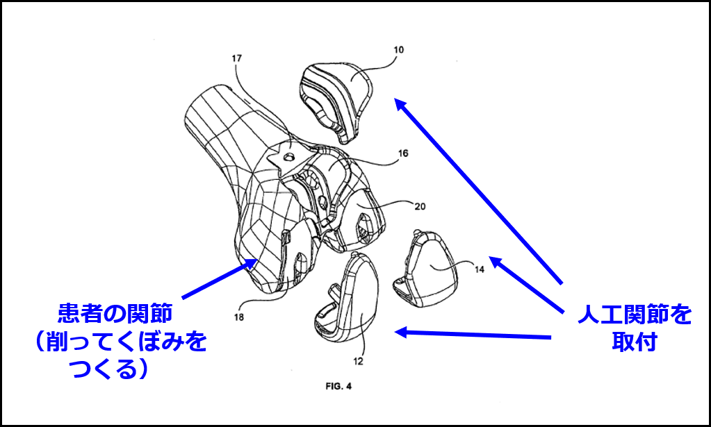 人工関節の置換手術のイメージ（ストライカーの特許JP5964955B2の図に追記して作成）