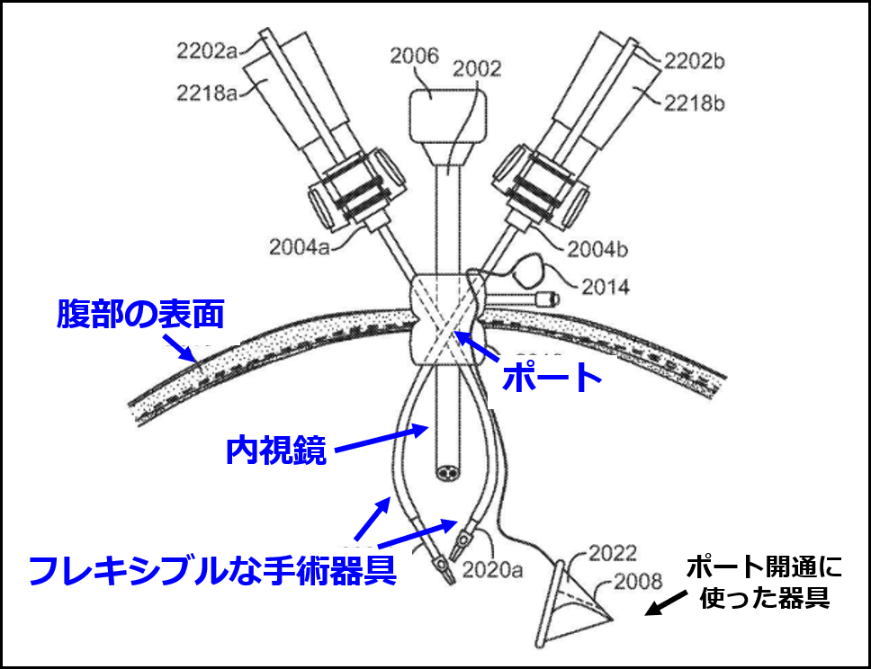 シングルポート手術のイメージ（JP5833204B2 の図に追記して作成）